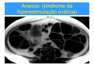 Anexos: (síndrome da hiperestimulação ovárica) 