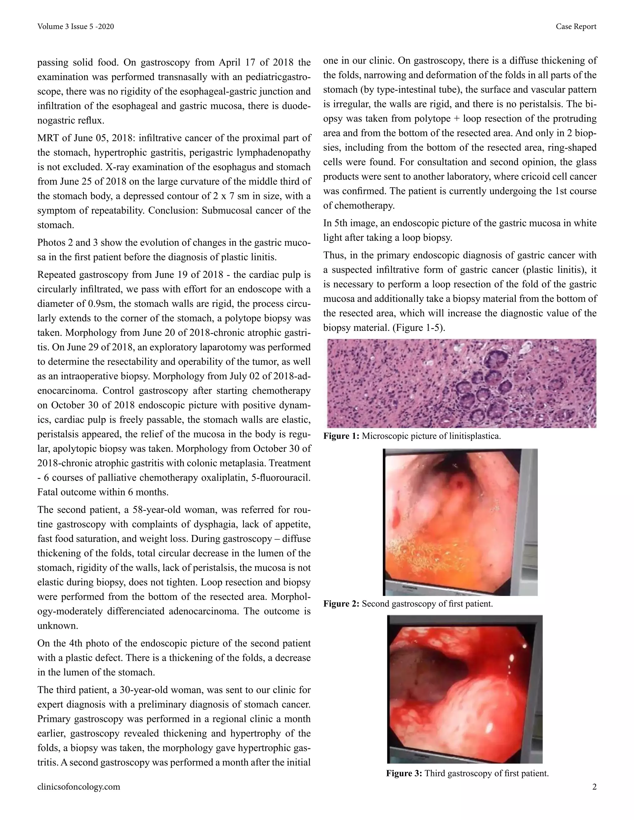 Linitis Plastica, Our Experience with the Diagnosis