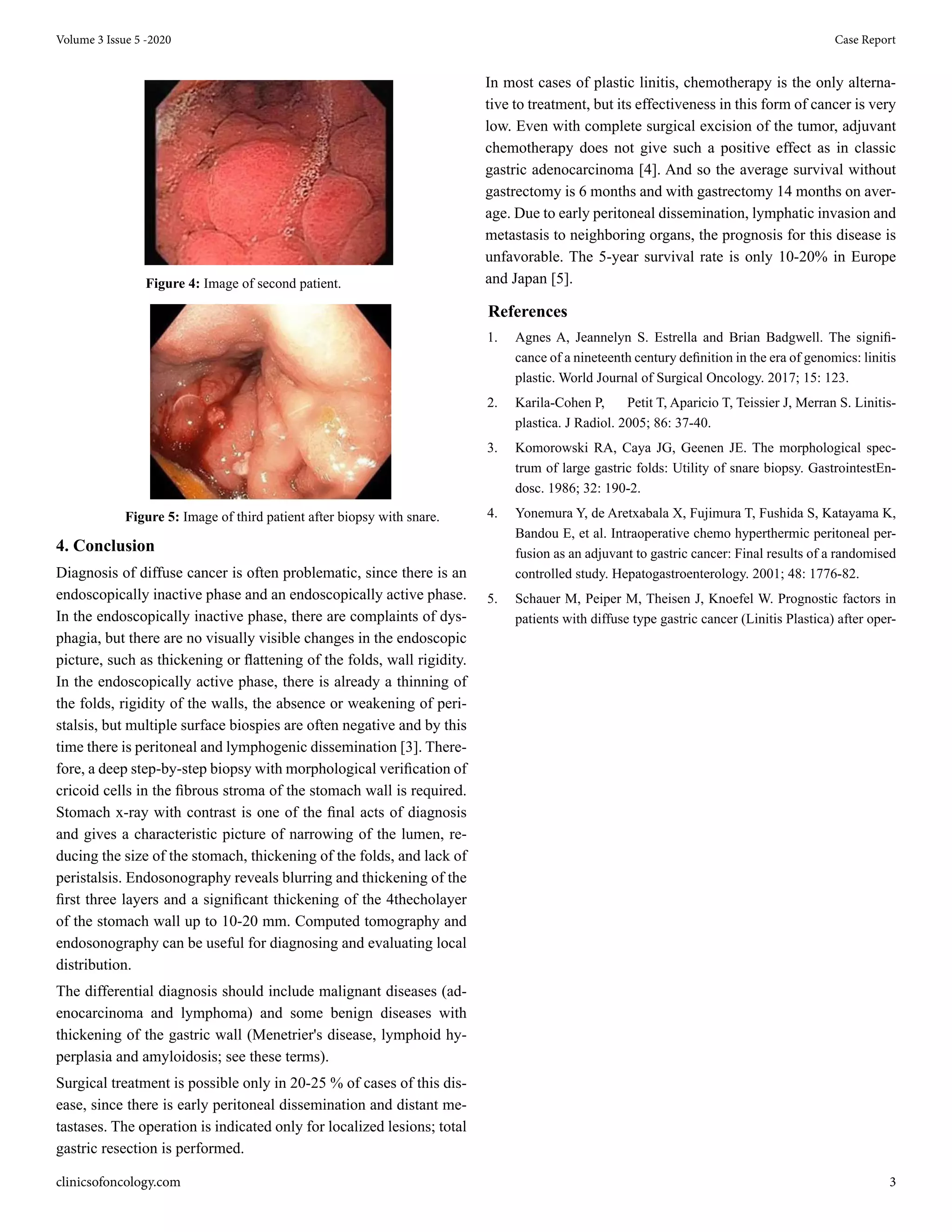 Linitis Plastica, Our Experience with the Diagnosis