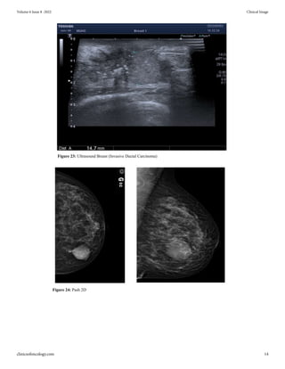 Breast Anatomy Types of Breast Tissues • Fibrous • Fibro glandular