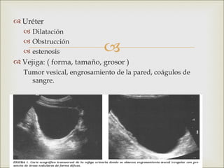  Uréter
    Dilatación

                            
    Obstrucción
    estenosis
 Vejiga: ( forma, tamaño, grosor )
   Tumor vesical, engrosamiento de la pared, coágulos de
     sangre.
 