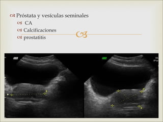  Próstata y vesículas seminales
   CA

                          
   Calcificaciones
   prostatitis
 