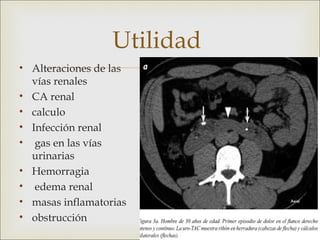 Utilidad
•   Alteraciones de las
    vías renales
                        
• CA renal
• calculo
• Infección renal
• gas en las vías
  urinarias
• Hemorragia
• edema renal
• masas inflamatorias
• obstrucción
 