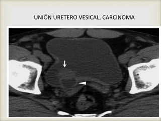 UNIÓN URETERO VESICAL, CARCINOMA

            
 