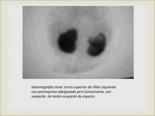 



Gammagrafía renal: tercio superior de riñón izquierdo
con parénquima adelgazado pero funcionante, con
sospecha de lesión ocupante de espacio.
 