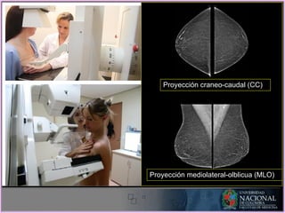 Proyección craneo-caudal (CC)
Proyección mediolateral-olblicua (MLO)
 