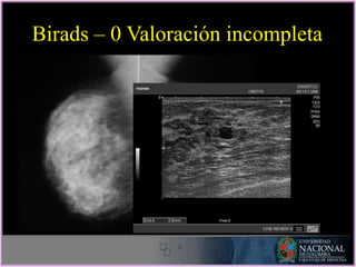 Birads – 0 Valoración incompleta
 