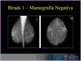 Birads 1 – Mamografía Negativa
 