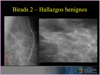 Birads 2 – Hallazgos benignos
 