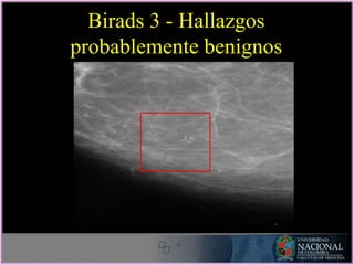 Birads 3 - Hallazgos
probablemente benignos
 
