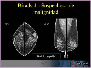 MLO
CC
Birads 4 - Sospechoso de
malignidad
Nódulo palpable
 