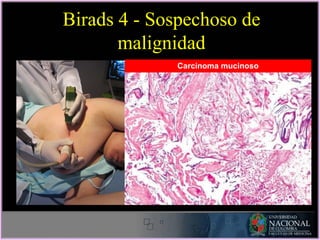Birads 4 - Sospechoso de
malignidad
Carcinoma mucinoso
 