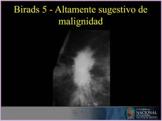 Birads 5 - Altamente sugestivo de
malignidad
 