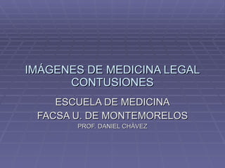 IMÁGENES DE MEDICINA LEGAL CONTUSIONES ESCUELA DE MEDICINA FACSA U. DE MONTEMORELOS PROF. DANIEL CHÀVEZ 