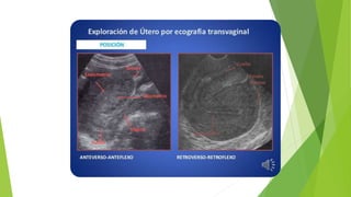 Imágenes de útero y miomas.pptx