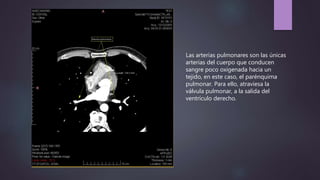 Las arterias pulmonares son las únicas
arterias del cuerpo que conducen
sangre poco oxigenada hacia un
tejido, en este caso, el parénquima
pulmonar. Para ello, atraviesa la
válvula pulmonar, a la salida del
ventrículo derecho.
 