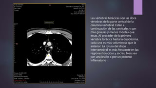 Las vértebras torácicas son las doce
vértebras de la parte central de la
columna vertebral. Están a
continuación de las cervicales y son
más gruesas y menos móviles que
estas. Al proceder de la primera
vértebra torácica hasta la duodécima,
cada una es más voluminosa que la
anterior. La rotura del disco
intervertebral es más frecuente en las
regiones torácicas y sacras, bien sea
por una lesión o por un proceso
inflamatorio
 