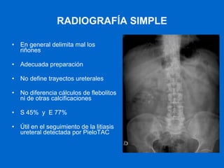 RADIOGRAFÍA SIMPLE En general delimita mal los riñones Adecuada preparación  No define trayectos ureterales No diferencia cálculos de flebolitos ni de otras calcificaciones S 45%  y  E 77% Útil en el seguimiento de la litiasis ureteral detectada por PieloTAC 