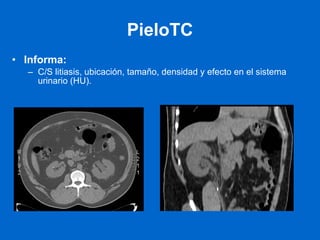 PieloTC Informa:   C/S litiasis, ubicación, tamaño, densidad y efecto en el sistema urinario (HU). 