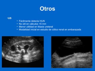 Otros US Fácilmente detecta HUN No útil en cálculos <5 mm Menor utilidad en litiasis ureteral Modalidad inicial en estudio de cólico renal en embarazada 