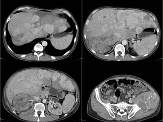 Otros Pielografía de Eliminación: Solo identifica  21% de las masas  <  2 cm. 52% de 2 a 3 cm.  82%  >  a 3 cm.  Sospecha de masa renal  ->  continuar estudio con TC o RM US: A mayor tamaño tumoral, mayor grado de certeza diagnóstica.  Lesiones hipoecogenicas, heterogeneas  Warshauer y otros :  85% de detección  en lesiones >  3 cm.   <  60% en lesiones < 2 cm. 