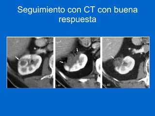 Estudio de Elección:   TC Trifásica Abdominal   Estudio sin contraste, contrastado en fases arterial, portal y tardía Informa: Laceraciones Locación de hematomas Extravasación arterial activa  Segmentos renales desvascularizados Extravasación urinaria 