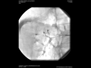 US La mayoría riñones con PNA son normales a la eco. Aumento de tamaño renal. Compresión del seno renal. Alteración de la ecogenicidad con hipoecogenicidad. (edema) o con hiperecogenicidad (hemorragia). Pérdida de la diferencia corticomedular. Masa o masas  mal delimitadas. Gas en parénquima renal. Dilatación de la pelvis renal y material ecogenico en suspensión. Engrosamiento difuso del urotelio. 