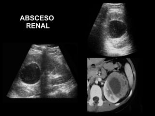 Hipertensión: causas renales 6-10% causa secundaria. La imagenología participa en : Diagnóstico etiológico. Seguimiento de las complicaciones  (daño renal crónico)  Tratamiento de algunas de sus causas (radiología intervencional). 