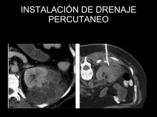 Causas renales  RENOVASCULAR ATE. Displasia fibromuscular. Aneurisma arteria renal. Disección de arteria renal. Vasculitis. Neurofibromatosis. DEL PARÉNQUIMA RENAL Nefropatías:  Diabética. Glomérulonefritis. LES. Pielonefritis crónica. Enfermedad poliquística renal. 