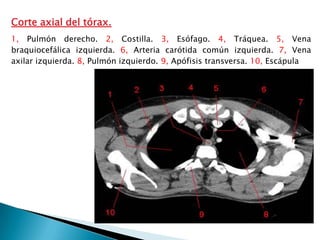 Corte axial del tórax.
1, Pulmón derecho. 2, Costilla. 3, Esófago. 4, Tráquea. 5, Vena
braquiocefálica izquierda. 6, Arteria carótida común izquierda. 7, Vena
axilar izquierda. 8, Pulmón izquierdo. 9, Apófisis transversa. 10, Escápula
 