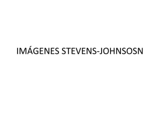 IMÁGENES STEVENS-JOHNSOSN
 