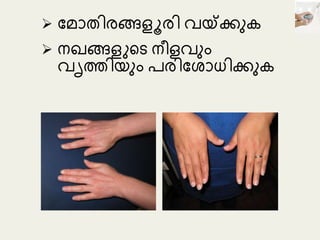  മ ോതിരങ്ങളൂരി വയ്ക്കുക
 നഖങ്ങളുടെ നീളവുും
വൃത്തിയുും പരിമ ോധികുക
 