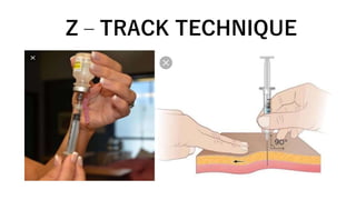 Z – TRACK TECHNIQUE
 