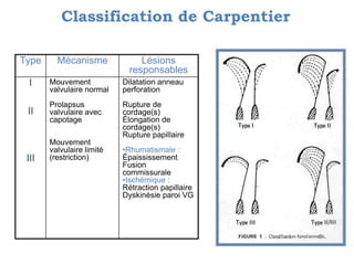 Classification de Carpentier 
Type Mécanisme Lésions 
responsables 
I 
II 
III 
Mouvement 
valvulaire normal 
Prolapsus 
valvulaire avec 
capotage 
Mouvement 
valvulaire limité 
(restriction) 
Dilatation anneau 
perforation 
Rupture de 
cordage(s) 
Élongation de 
cordage(s) 
Rupture papillaire 
•Rhumatismale : 
Épaississement 
Fusion 
commissurale 
•Ischémique : 
Rétraction papillaire 
Dyskinésie paroi VG 
 