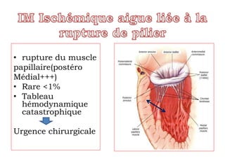 • rupture du muscle 
papillaire(postéro 
Médial+++) 
• Rare <1% 
• Tableau 
hémodynamique 
catastrophique 
Urgence chirurgicale 
 