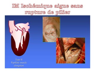 Ischemic Mitral Regurgitation 
IIschemiic miittrrall rregurrgiittattiion:: Type IIII dysffuncttiion 
Type II 
Papillary muscle 
ellongattiion 
 