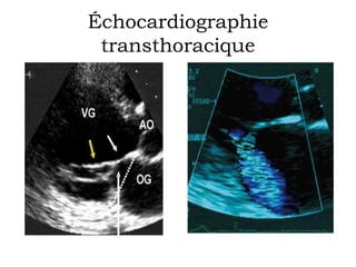 Échocardiographie 
transthoracique 
 