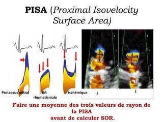 PISA (Proximal Isovelocity 
Surface Area) 
Prolapsus mitral IM ischémique 
rhumatismale 
 
