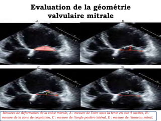 Evaluation de la géométrie 
valvulaire mitrale 
Mesures de déformation de la valve mitrale, A : mesure de l’aire sous la tente en vue 4 cavités, B : 
mesure de la zone de coaptation, C : mesure de l’angle postéro latéral, D : mesure de l’anneau mitral. 
 