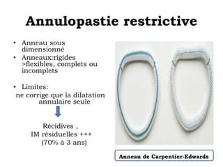 Annulopastie restrictive 
• Anneau sous 
dimensionné 
• Anneaux:rigides 
>flexibles, complets ou 
incomplets 
• Limites: 
ne corrige que la dilatation 
annulaire seule 
Récidives , 
IM résiduelles +++ 
(70% à 3 ans) 
Anneau de Carpentier-Edwards 
 