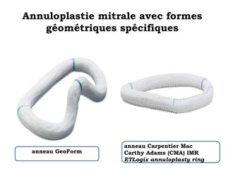 Annuloplastie mitrale avec formes 
géométriques spécifiques 
anneau GeoForm 
anneau Carpentier Mac 
Carthy Adams (CMA) IMR 
ETLogix annuloplasty ring 
 