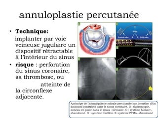 annuloplastie percutanée 
• Technique: 
implanter par voie 
veineuse jugulaire un 
dispositif rétractable 
à l’intérieur du sinus 
• risque : perforation 
du sinus coronaire, 
sa thrombose, ou 
atteinte de 
la circonflexe 
adjacente. 
Aprincipe de l’annuloplastie mitrale percutanée par insertion d’un 
dispositif constrictif dans le sinus coronaire. B : fluoroscopie, 
anneau en place dans le sinus coronaire. C : système Monarc, 
abandonné. D : système Carillon. E :système PTMA, abandonné 
 