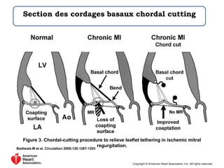 Section des cordages basaux chordal cutting 
Figure 3. Chordal-cutting procedure to relieve leaflet tethering in ischemic mitral 
regurgitation. 
Badiwala M et al. Circulation 2009;120:1287-1293 
Copyright © American Heart Association, Inc. All rights reserved. 
 