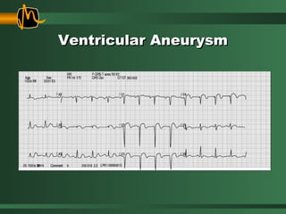 Ventricular AneurysmVentricular Aneurysm
 
