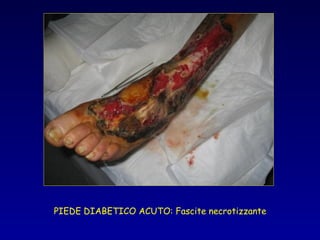 PIEDE DIABETICO ACUTO: Fascite necrotizzante
 