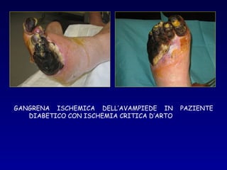 27 gen 2009
GANGRENA ISCHEMICA DELL’AVAMPIEDE IN       PAZIENTE
   DIABETICO CON ISCHEMIA CRITICA D’ARTO
 