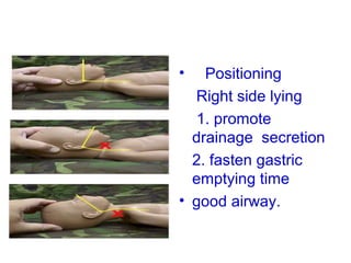 POSITIONING OF THE
     NEWBORN
         •   Positioning
           Right side lying
           1. promote
           drainage secretion
           2. fasten gastric
           emptying time
         • good airway.
 