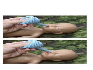 Suction first from Mouth and then from
Nose Use a by use of bulb syringe
 