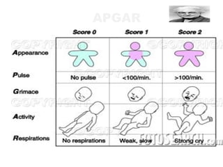 APGAR
 