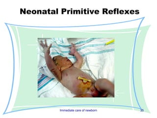 Neonatal Primitive Reflexes




         Immediate care of newborn   35
 